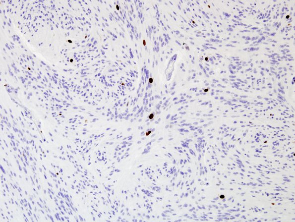 1F Ependymoma, tanycytic (Case 1) Ki67 2