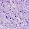 1G1 Ependymoma, tanycytic (Case 1) Plastic 1 (2)