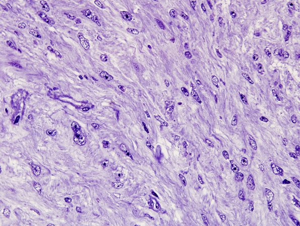 1G1 Ependymoma, tanycytic (Case 1) Plastic 1 (2)