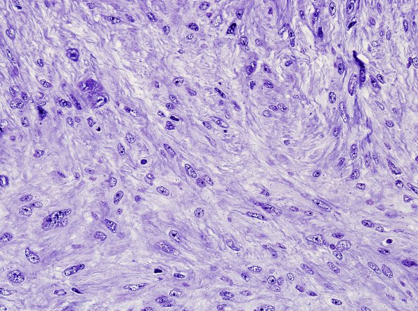 1G2 Ependymoma, tanycytic (Case 1) Plastic 2 (2).