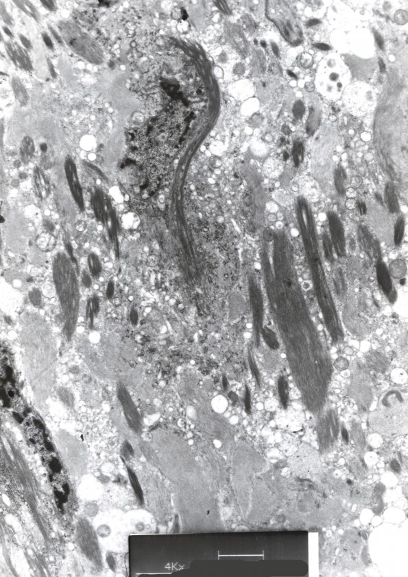 1H1 Ependymoma, tanycytic (Case 1) EM 2 - Copy