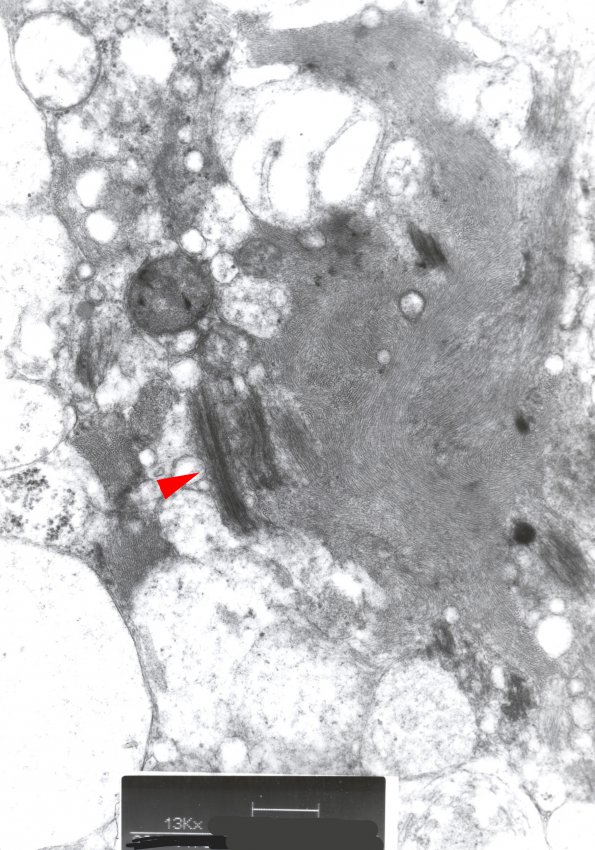 1H2 Ependymoma, tanycytic (Case 1) EM 1 copy - Copy