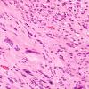 2A2 Ependymoma, tanycytic (Case 2) H&E 1 (2)