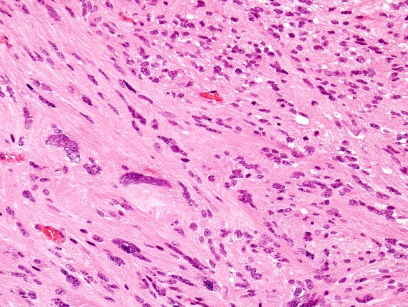 2A2 Ependymoma, tanycytic (Case 2) H&E 1 (2)