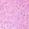 2A3 Ependymoma, tanycytic (Case 2) H&E 7