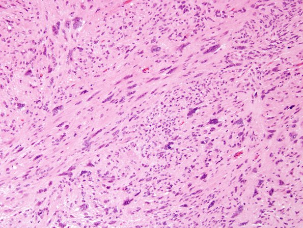 2A3 Ependymoma, tanycytic (Case 2) H&E 7