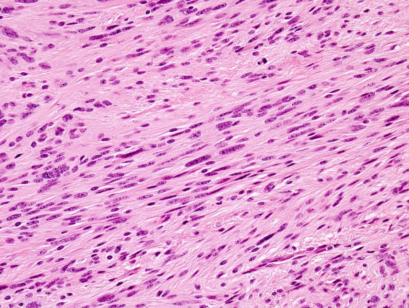 2A4 Ependymoma, tanycytic (Case 2) H&E 3