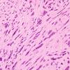 2A5 Ependymoma, tanycytic (Case 2) H&E 4