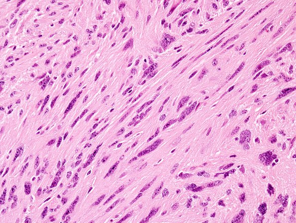 2A5 Ependymoma, tanycytic (Case 2) H&E 4