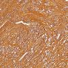 2B1 Ependymoma, tanycytic (Case 2) GFAP 3