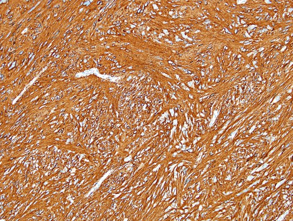 2B1 Ependymoma, tanycytic (Case 2) GFAP 3