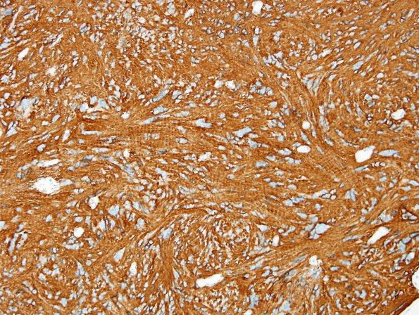 2B2 Ependymoma, tanycytic (Case 2) GFAP 2