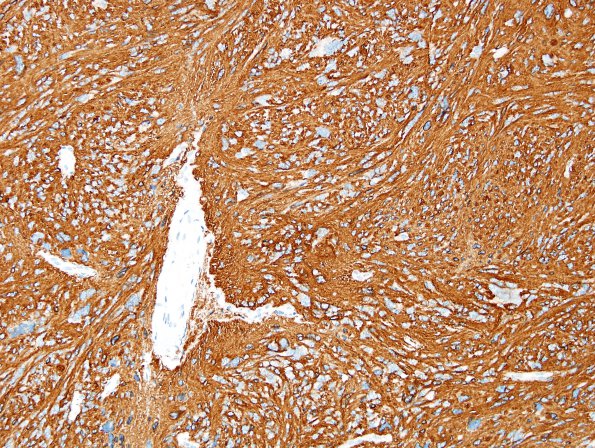 2C Ependymoma, tanycytic (Case 2) CD99 2