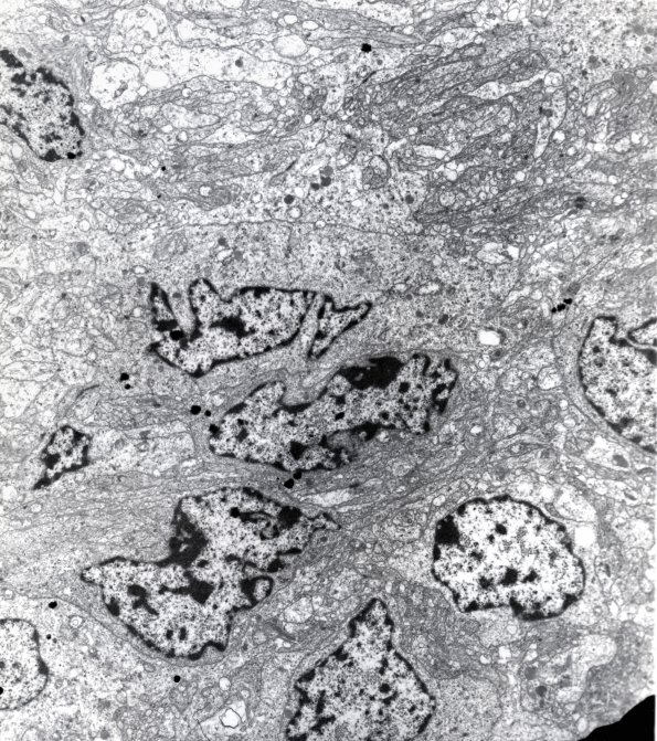 2D1 Ependymoma, tanycytic (Case 2) EM 3 - Copy