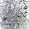 2D2 Ependymoma, tanycytic (Case 2) EM 1 copy - Copy