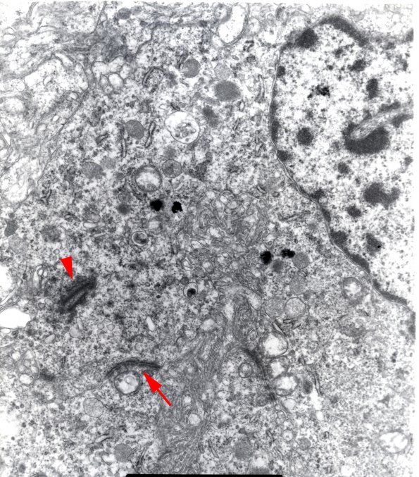 2D2 Ependymoma, tanycytic (Case 2) EM 1 copy - Copy