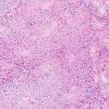 3A1 Ependymoma, tanycytic (Case 3) H&E 2