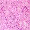 3A3 Ependymoma, tanycytic (Case 3) H&E 3