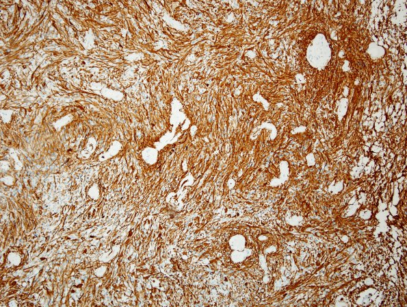 3B1 Ependymoma, tanycytic (Case 3) GFAP 4