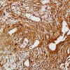 3B2 Ependymoma, tanycytic (Case 3) GFAP 3