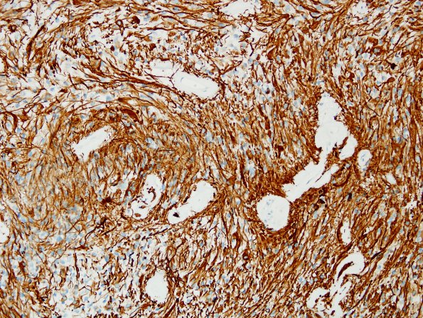 3B2 Ependymoma, tanycytic (Case 3) GFAP 3