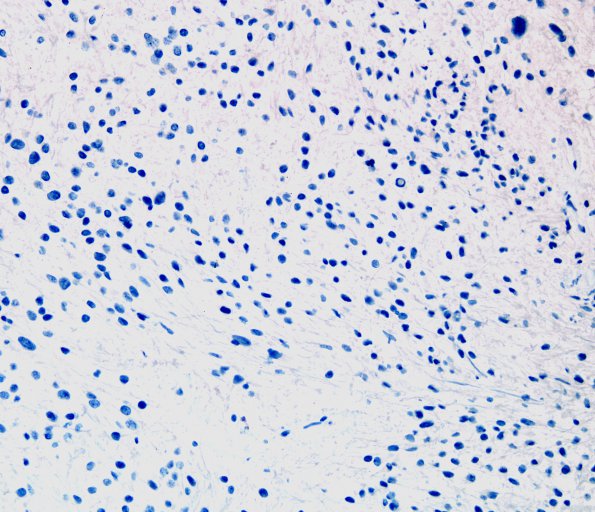 3D Ependymoma, tanycytic (Case 3) Ki67 2