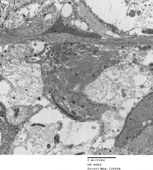 3E1 Ependymoma, tanycytic (Case 3) EM 009 - Copy