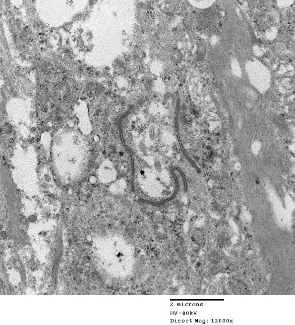 3E2 Ependymoma, tanycytic (Case 3) EM 011 - Copy