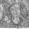 3E3 Ependymoma, tanycytic (Case 3) EM 012 - Copy