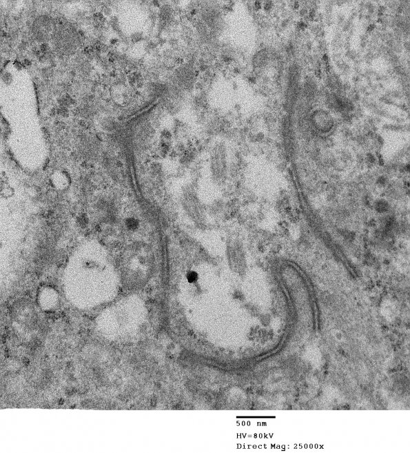 3E3 Ependymoma, tanycytic (Case 3) EM 012 - Copy