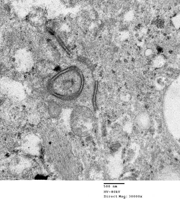 3E4 Ependymoma, tanycytic (Case 3) EM 007 - Copy