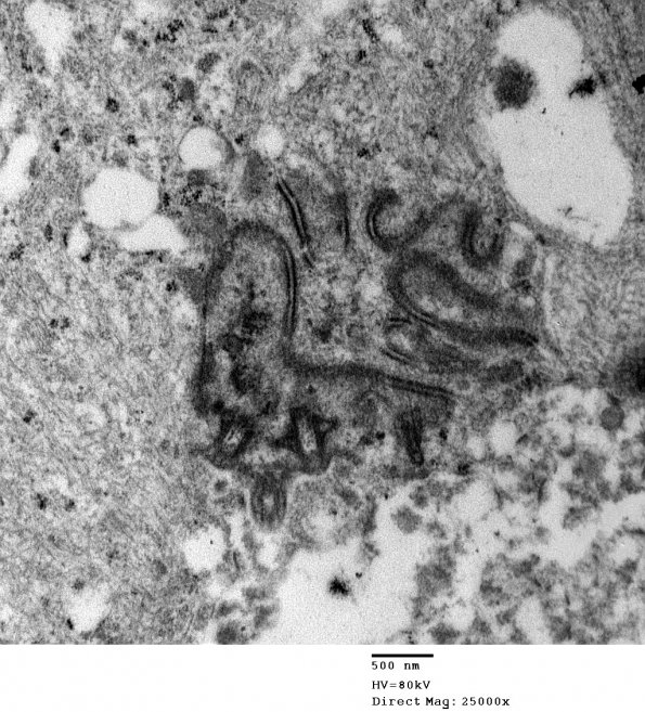 3E5 Ependymoma, tanycytic (Case 3) EM 015 - Copy