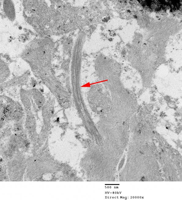 3E6 Ependymoma, tanycytic (Case 3) EM 017 copy - Copy