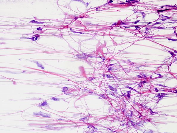 4A1 Ependymoma, tanycytic (Case 4) H&E 5