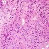 4A2 Ependymoma, tanycytic (Case 4) H&E 1