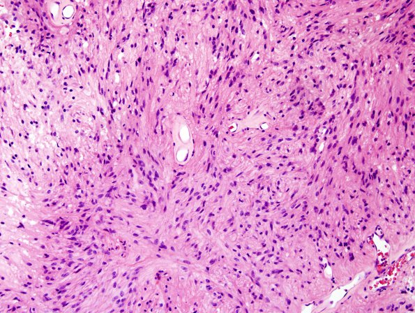 4A2 Ependymoma, tanycytic (Case 4) H&E 1