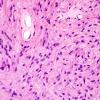 4A3 Ependymoma, tanycytic (Case 4) H&E 2