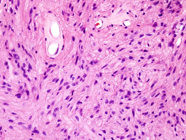 4A3 Ependymoma, tanycytic (Case 4) H&E 2