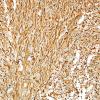 4B2 Ependymoma, tanycytic (Case 4) GFAP 4