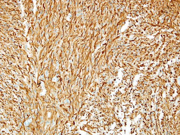 4B2 Ependymoma, tanycytic (Case 4) GFAP 4