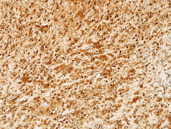 4C1 Ependymoma, tanycytic (Case 4) S100 1