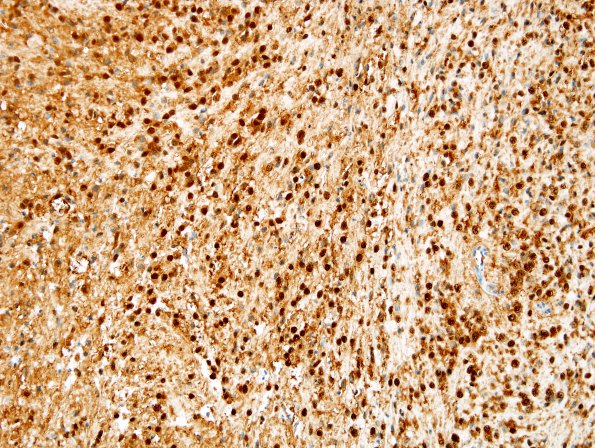 4C2 Ependymoma, tanycytic (Case 4) S100 2