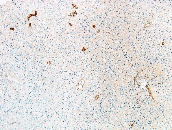 4F1 Ependymoma, tanycytic (Case 4) Coll IV 1