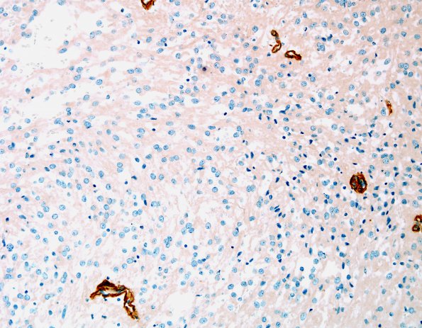 4F2 Ependymoma, tanycytic (Case 4) Coll IV 2