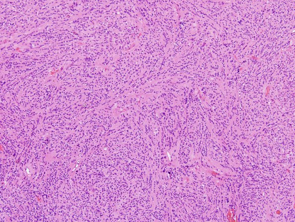 5A1 Ependymoma, tanycytic (Case 5) H&E 1