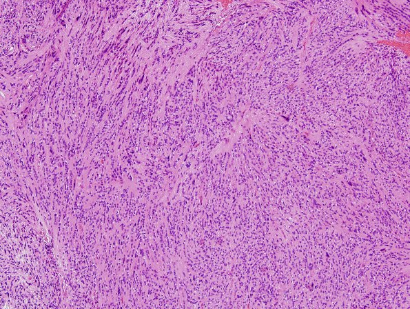 5A2 Ependymoma, tanycytic (Case 5) H&E 8