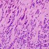 5A3 Ependymoma, tanycytic (Case 5) H&E 6