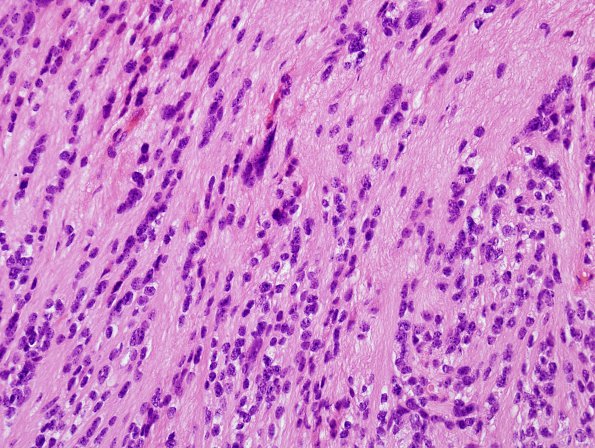 5A3 Ependymoma, tanycytic (Case 5) H&E 6