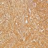 5B1 Ependymoma, tanycytic (Case 5) GFAP 4