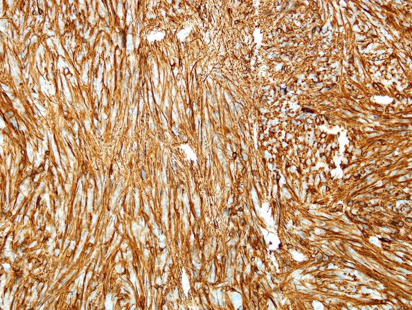 5B2 Ependymoma, tanycytic (Case 5) GFAP 3